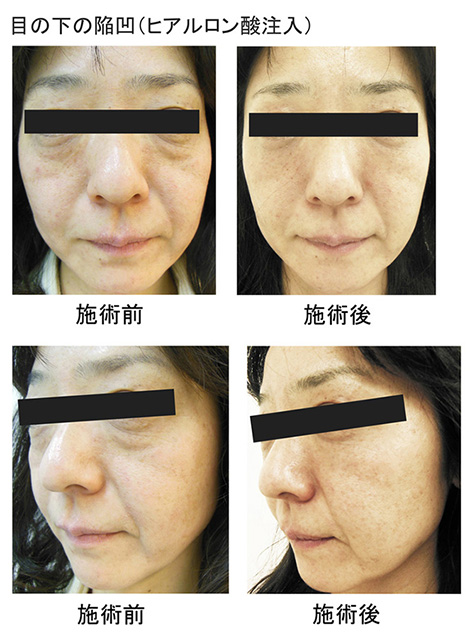 目の下の陥凹(ヒアルロン酸注入)