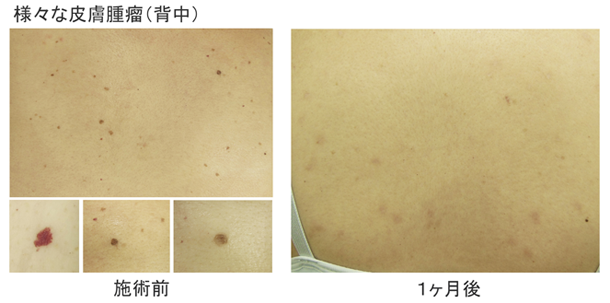 様々な腫瘤(背中)