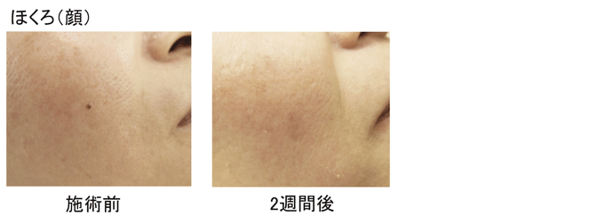 ホクロ、その他のできものの治療