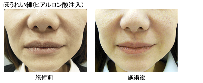 ほうれい線(ヒアルロン酸注入)
