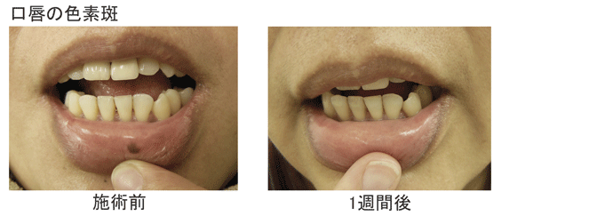 口唇の色素斑
