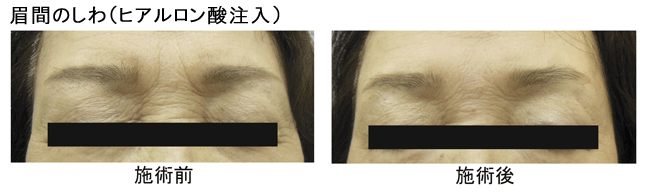 眉間のしわ(ヒアルロン酸注入)